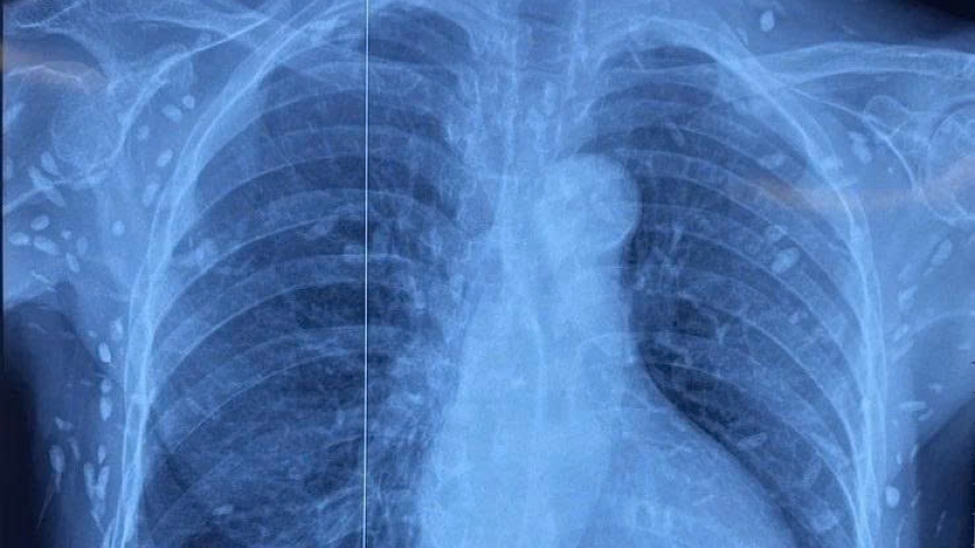 Phát hiện ca nhiễm ấu trùng sán dây lợn hiếm gặp ở bệnh nhân 77 tuổi