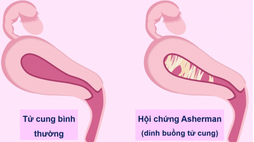 Nạo hút thai nhiều ảnh hưởng thế nào đến khả năng sinh sản