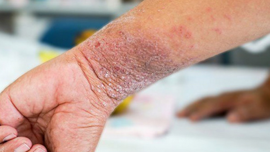 Đời sống vợ chồng tôi rối loạn vì bệnh viêm da cơ địa của chồng