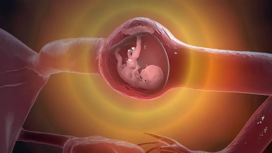 Suýt mất khả năng làm mẹ vì chửa ngoài tử cung