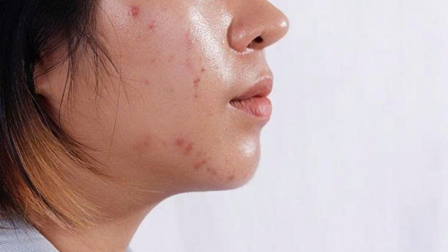 Cách làm sạch dầu trên da mặt an toàn và hiệu quả