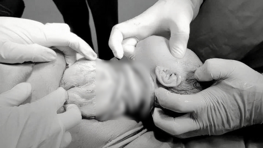 Bé gái chào đời với 6 vòng dây rốn quấn cổ, mẹ tiền sản giật