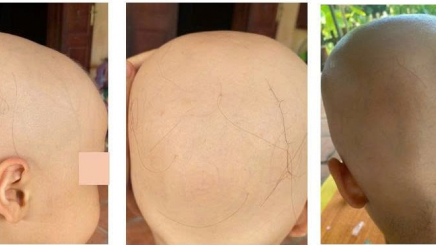 Điều trị thành công rụng tóc toàn thể ở bé 7 tuổi
