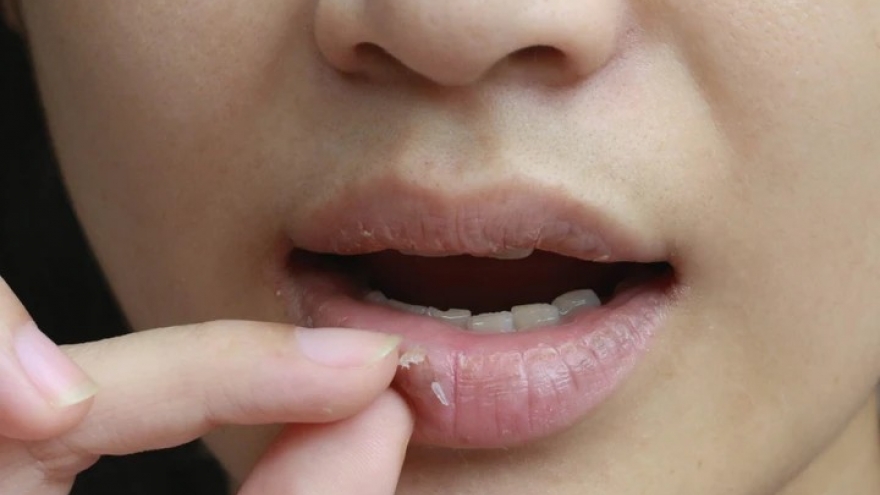 Dấu hiệu thiếu sắt cần biết sớm để kịp bổ sung