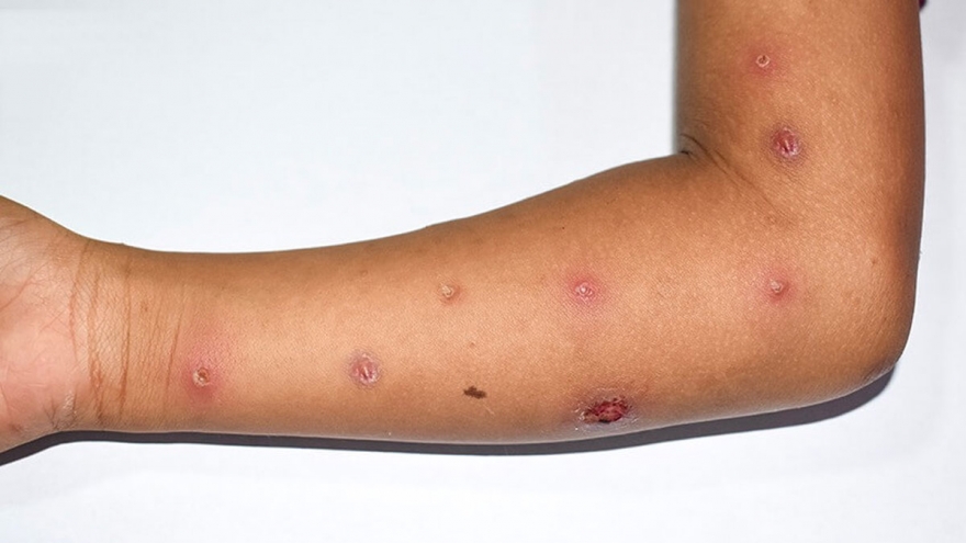 Chưa xác định được nguồn lây ca đậu mùa khỉ ở Đồng Nai