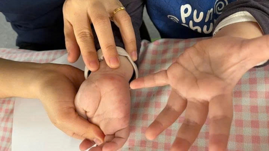 Tưởng con sốt phát ban, bà mẹ tá hỏa khi bác sĩ kết luận tay chân miệng