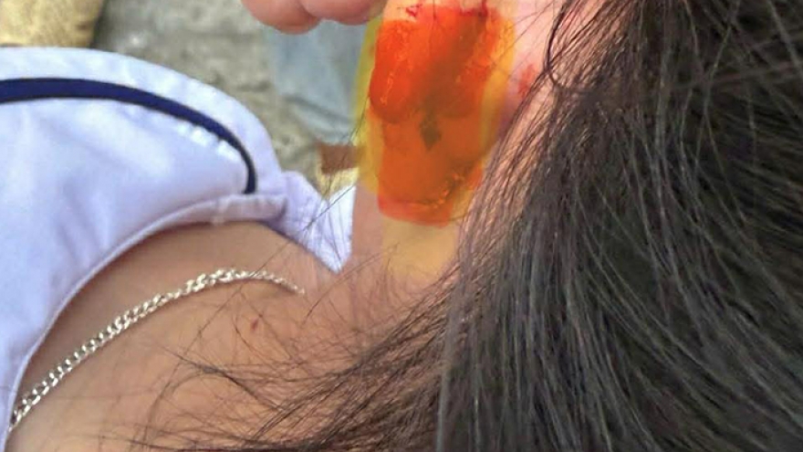 Học sinh lớp 1 bị cô giáo véo chảy máu tai, phụ huynh bức xúc đăng mạng