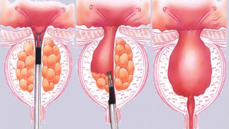 Những nguy cơ cần lưu ý sau khi phẫu thuật cắt tiền liệt tuyến