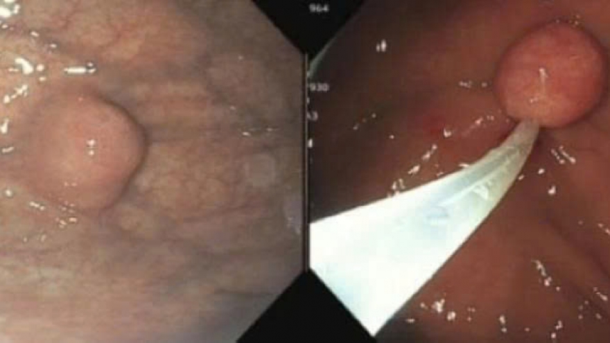 Phát hiện khối u dạ dày 1,4 cm khi đi khám sức khỏe định kỳ