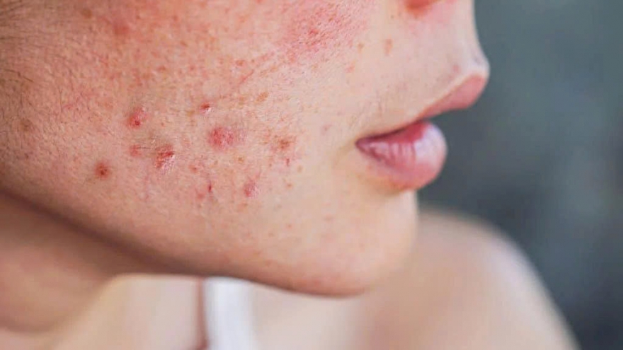 Da nổi mụn do nóng gan? Nên uống gì để thanh lọc và cải thiện làn da