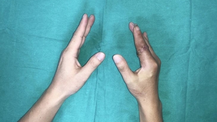 Ngón tay thủy thủ "sống lại" sau 25 giờ đứt rời giữa tâm bão