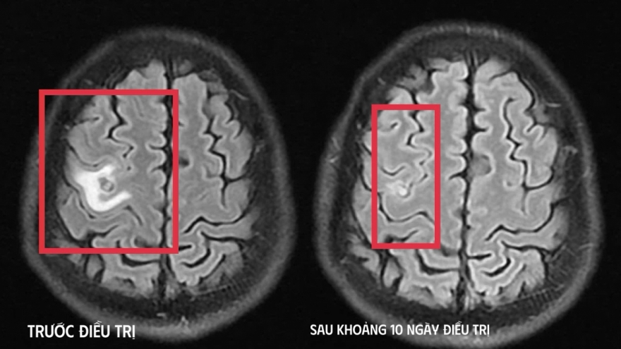 Phát hiện tổn thương não do ký sinh trùng từ triệu chứng giống u não