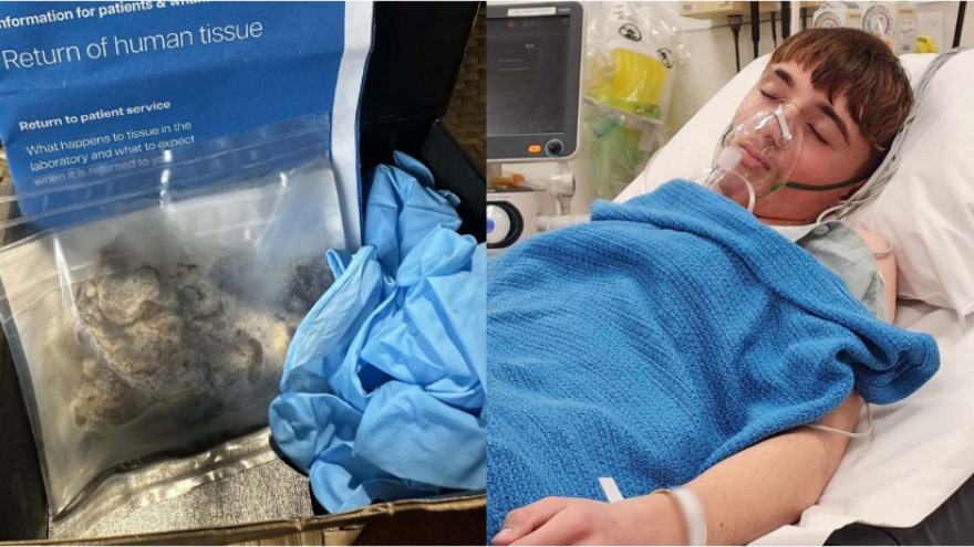 Hút thuốc lá điện tử từ năm 14 tuổi, nam sinh nhập viện khẩn cấp vì xẹp phổi