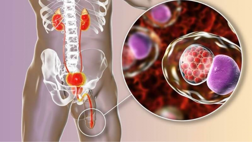 Bị đau niệu đạo hơn 5 năm nay không khám, tôi đang phải trả giá đắt vì chủ quan