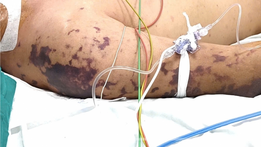 Ăn thịt lợn ở đám cỗ, người đàn ông nguy kịch vì nhiễm não mô cầu