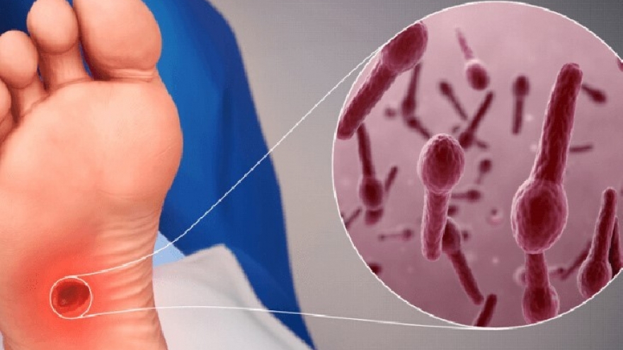 Tôi phải sống chung với mất ngủ kinh niên sau lần chết hụt vì nhiễm uốn ván