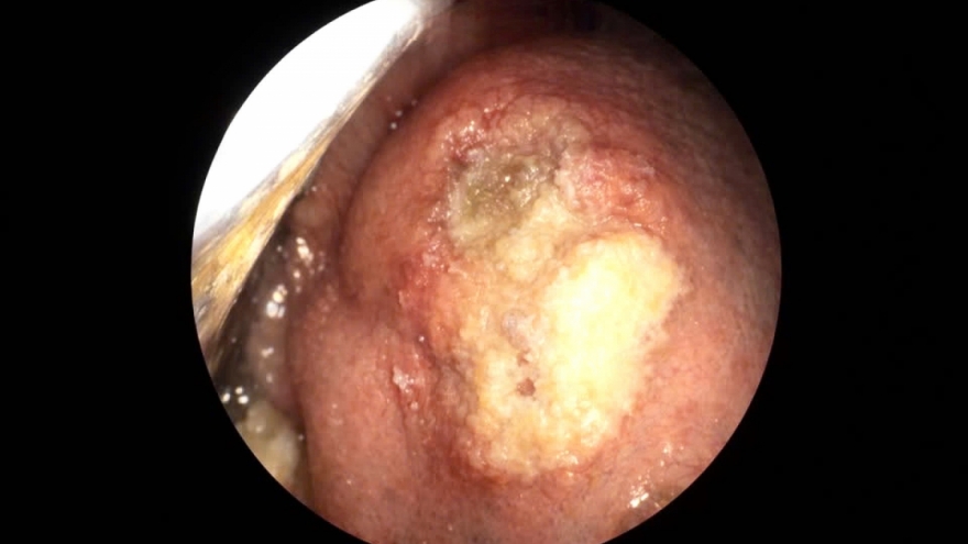 Đừng chủ quan với vết loét ở lưỡi, có thể là chỉ dấu của bệnh ung thư