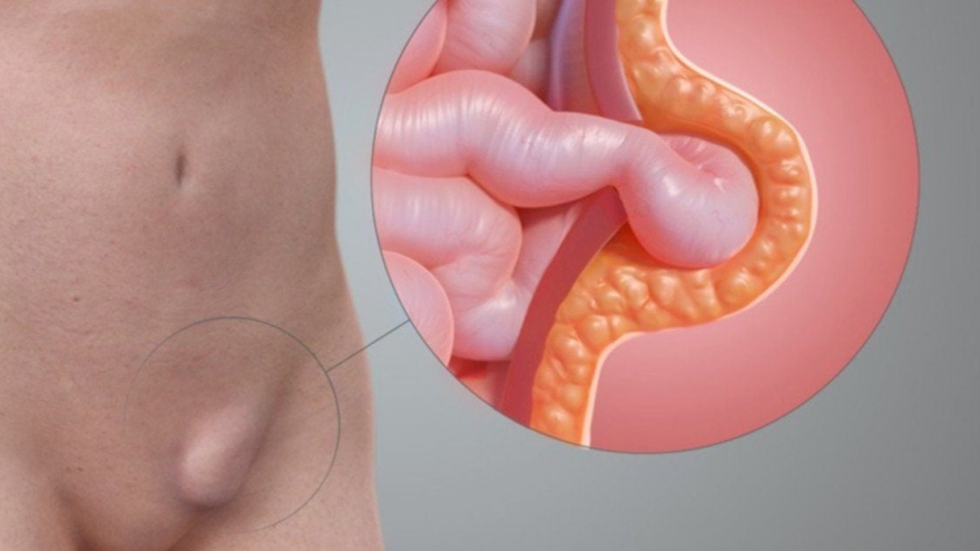 Đau vùng sinh dục sau mổ thoát vị bụng: Dấu hiệu bình thường hay biến chứng?