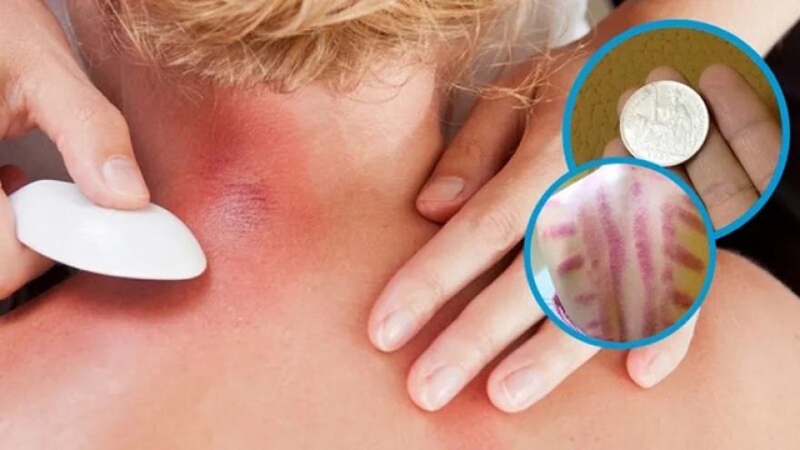 Vì sao đau mỏi người, "trúng gió" dùng đồ bạc, trứng gà để cạo gió?