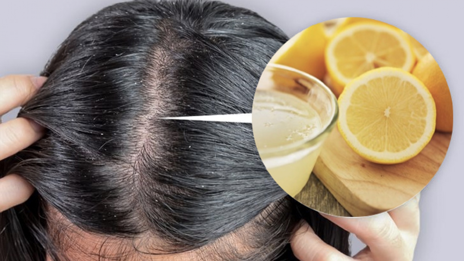 Trị gàu bằng chanh: Có thật sự hiệu quả như nhiều người vẫn làm?