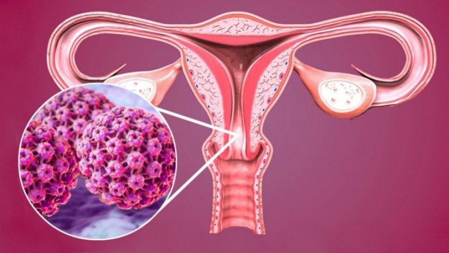 Nhiễm virus HPV sau mãn kinh: Vì sao uống và đặt thuốc vẫn không cải thiện?