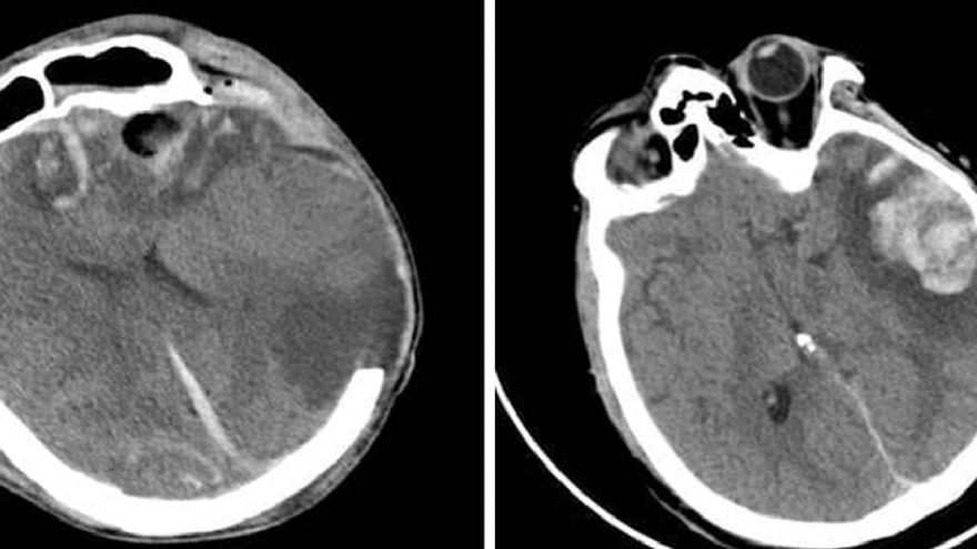 Russian mother and son saved after serious traffic accident in Vietnam