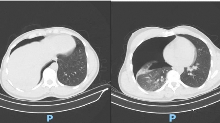 Russian tourist given overnight emergency care after traffic accident in HCM City