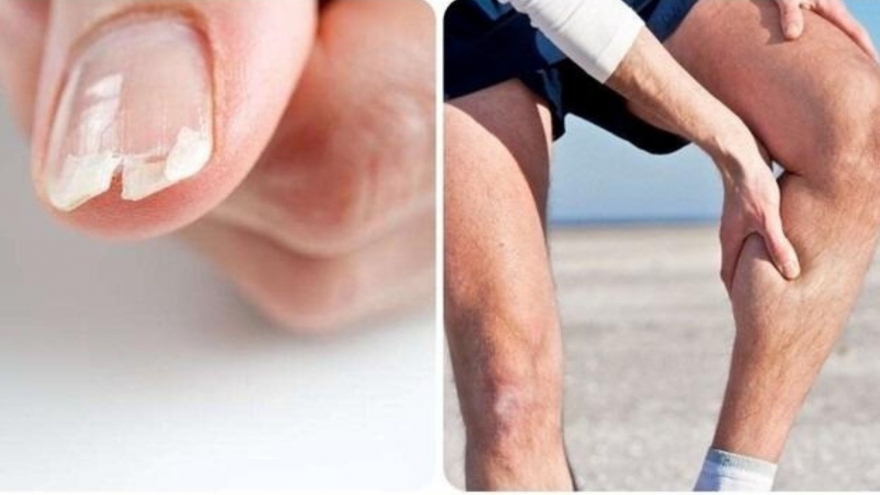 Dấu hiệu cảnh báo cơ thể đang thiếu canxi hay bị nhiều người bỏ qua