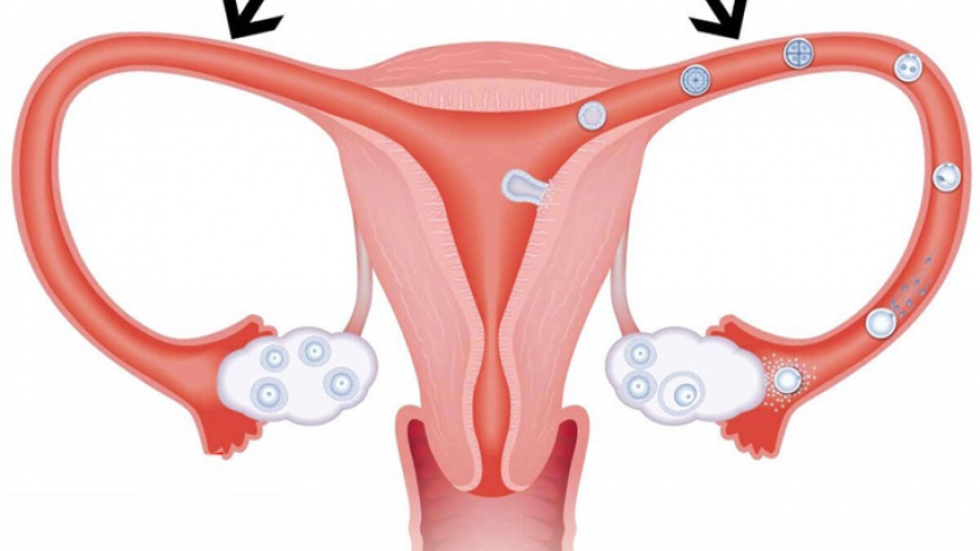 Mất hai ống dẫn trứng vì chửa ngoài dạ con, thụ tinh ống nghiệm có khó không?