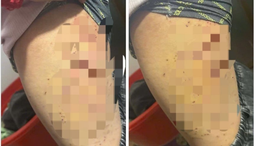 Nữ sinh lớp 7 bị bạn dùng bút bi đâm chi chít vào đùi