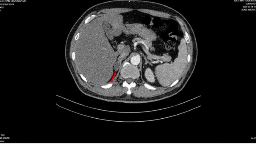 Người đàn ông phát hiện mắc hai bệnh ung thư cùng lúc