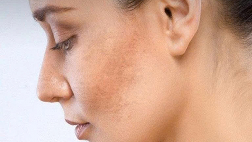 Vì sao da ngày càng sạm màu? Cách lấy lại làn da sáng khỏe