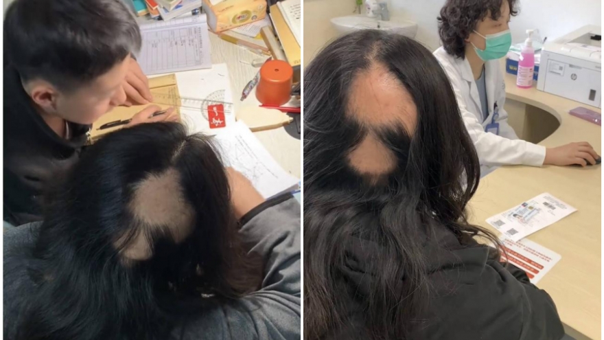 Hi hữu mẹ rụng tóc từng mảng vì áp lực thức khuya dạy con học