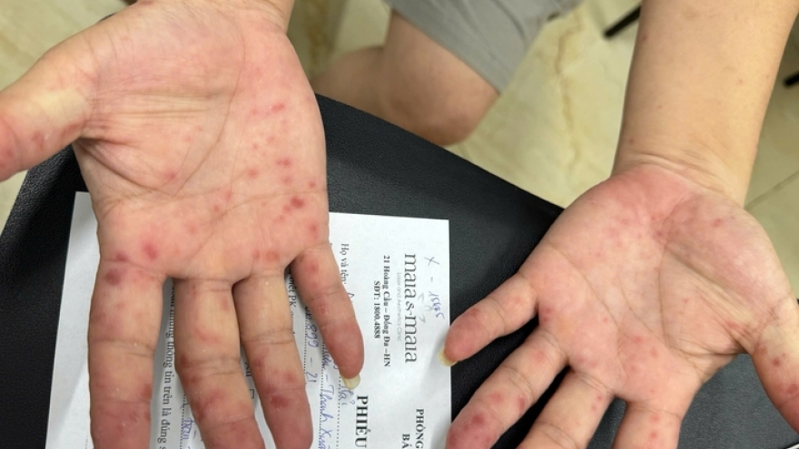 Ca mắc tay chân miệng tăng gấp 5 lần, 92% tập trung ở trẻ mầm non