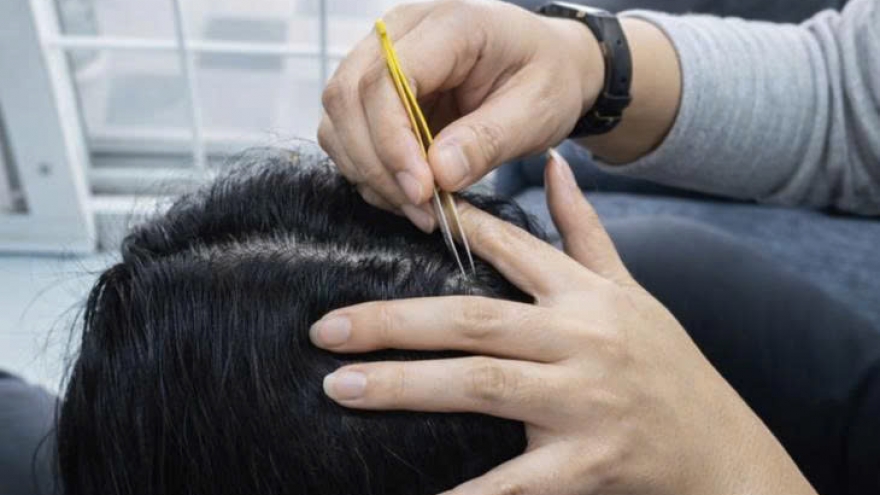 Nhổ tóc bạc cho "đỡ ngứa mắt", coi chừng tóc không mọc lại