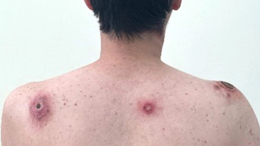 Giang mai - Nguy cơ nhiễm bệnh từ quan hệ tình dục không an toàn