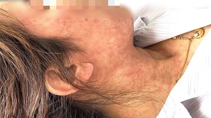 Người lớn gặp biến chứng nặng vì chủ quan bệnh sởi chỉ gặp ở trẻ em