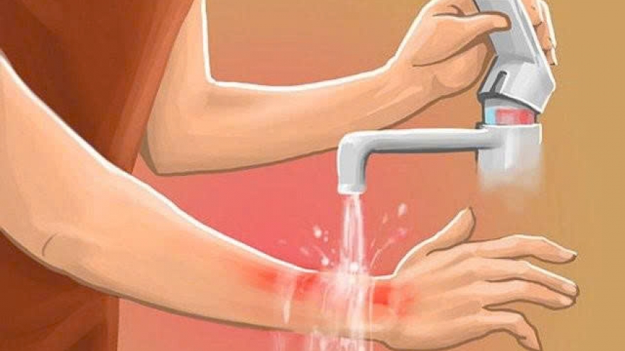 Bị bỏng nước sôi phải làm gì? Hướng dẫn xử trí và phòng tránh