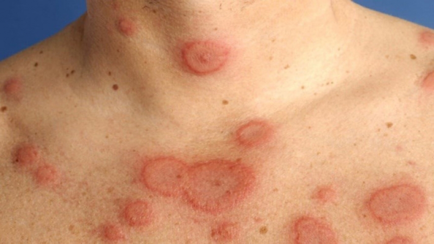 Căn bệnh nguy hiểm chỉ 10% được chẩn đoán sớm, có người vài năm mới phát hiện