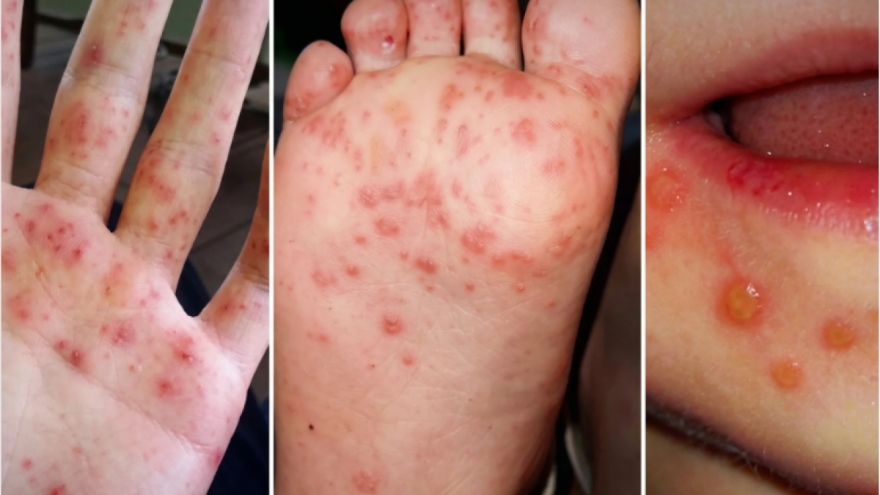 Cảnh báo từ chủng EV71 và giải pháp giảm ca nặng