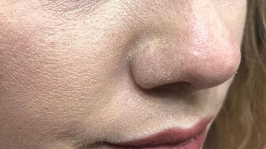 Thoa kem chống nắng bị mốc trắng: Nguyên nhân và cách xử lý nhanh