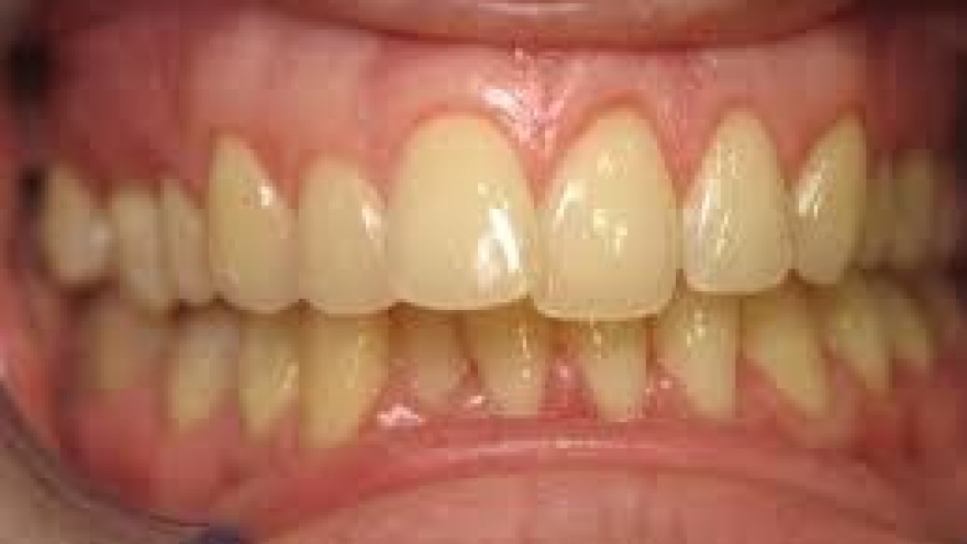 Răng cửa bị xỉn màu có đáng lo? Cách phòng tránh từ sớm