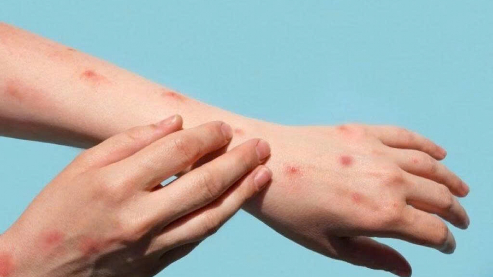 Thủy đậu tăng nhanh khi giao mùa: Làm gì để phòng bệnh hiệu quả?