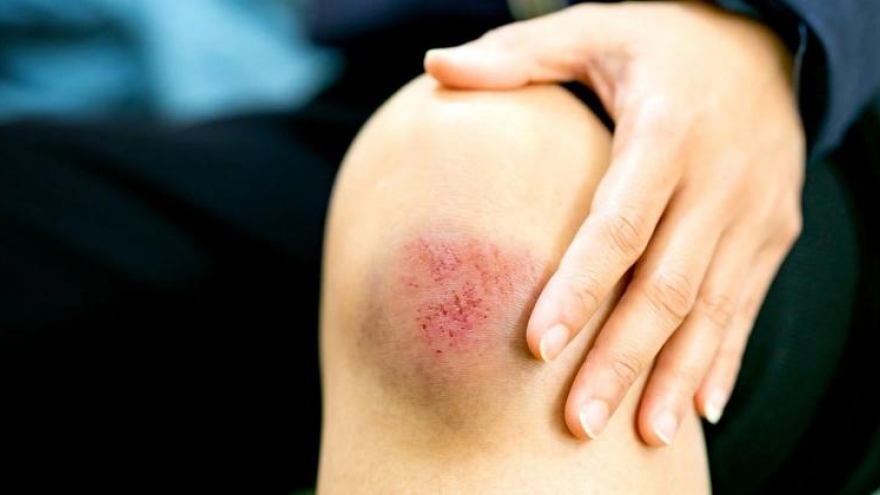Bị trầy xước da nên ăn gì để vết thương nhanh lành, hạn chế sẹo?
