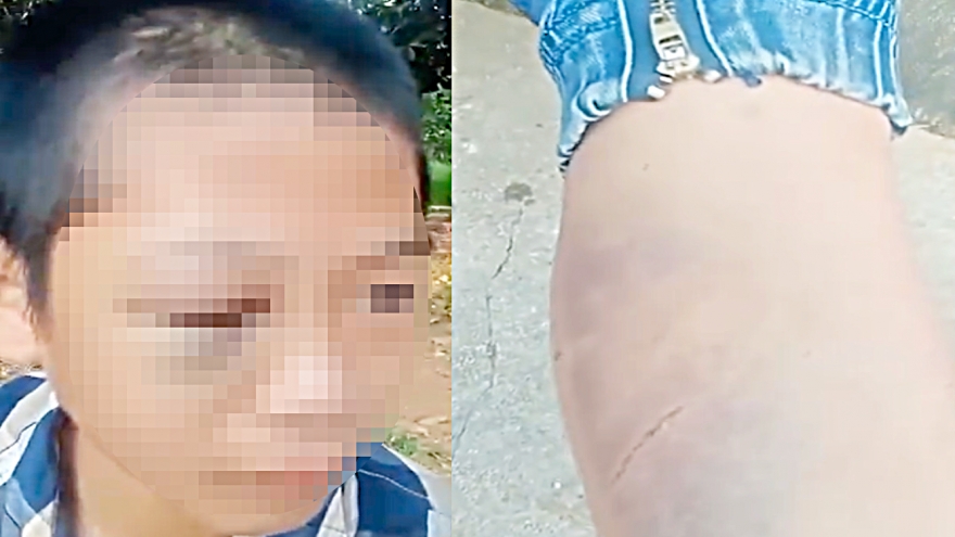Công an vào cuộc xác minh vụ bé trai lớp 6 ở Nghệ An nghi bị bạo hành