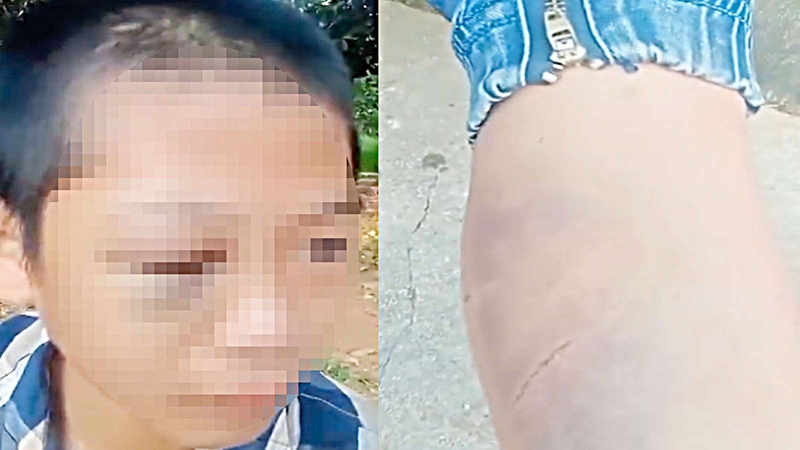 Công an vào cuộc xác minh vụ bé trai lớp 6 ở Nghệ An nghi bị bạo hành