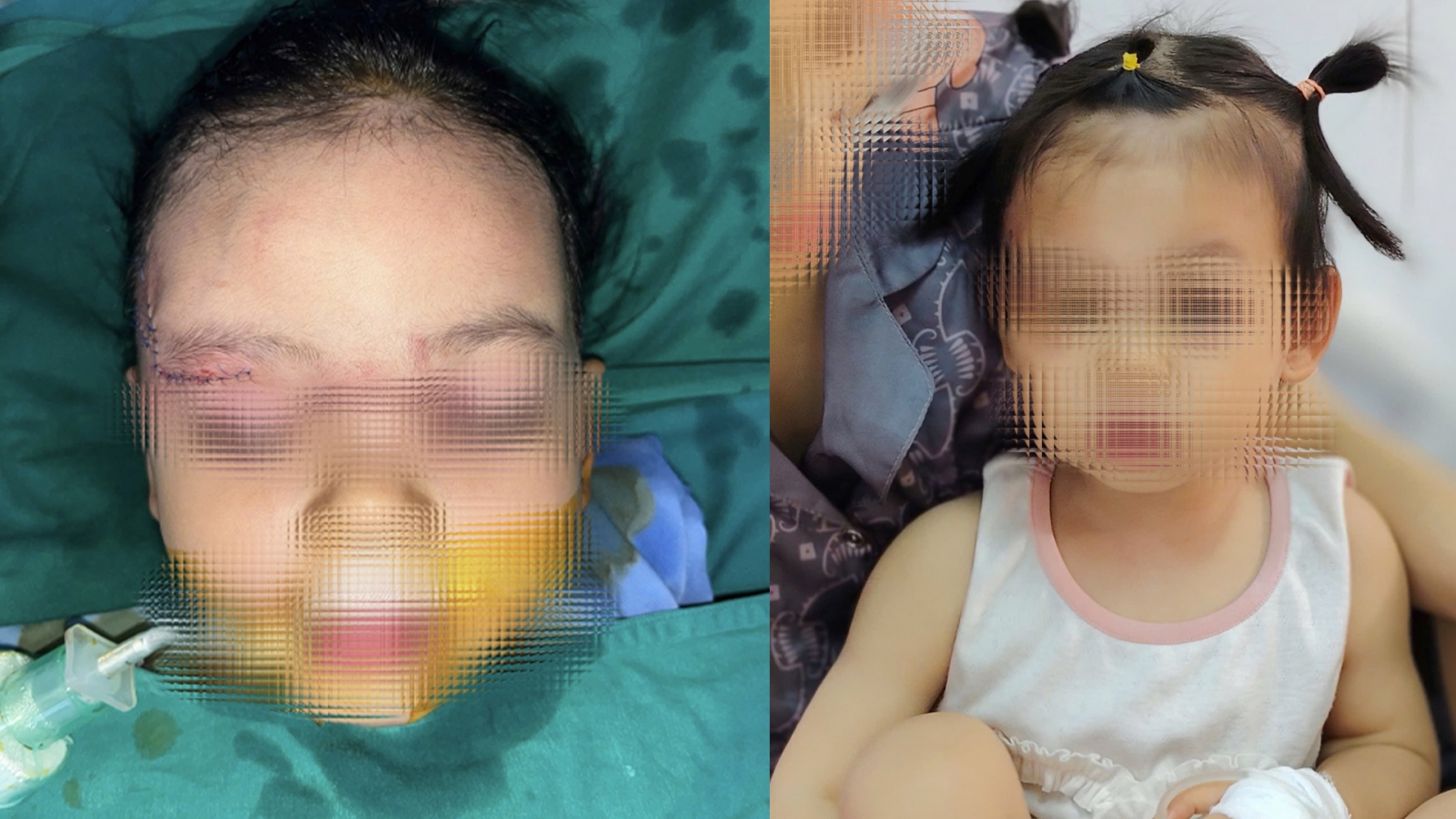 Bé gái 22 tháng tuổi bị chó cắn tổn thương nghiêm trọng khuôn mặt