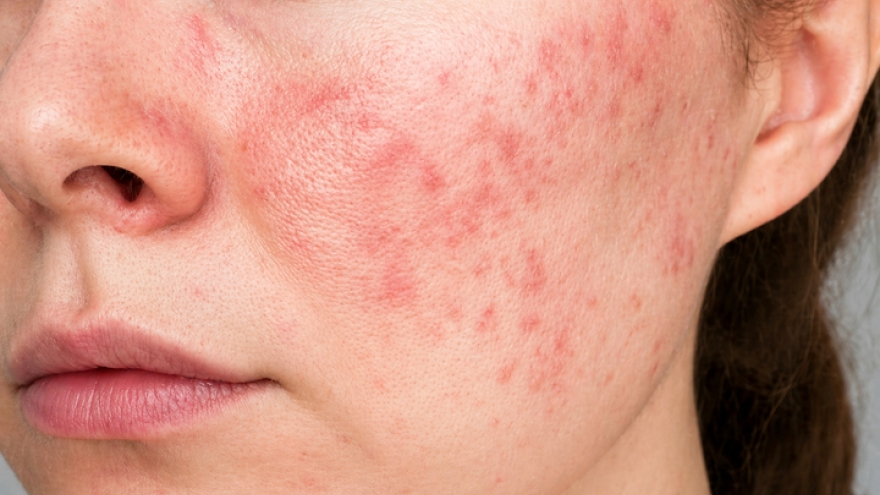 Hiểm họa khi tự ý lạm dụng thuốc, mỹ phẩm chứa corticoid