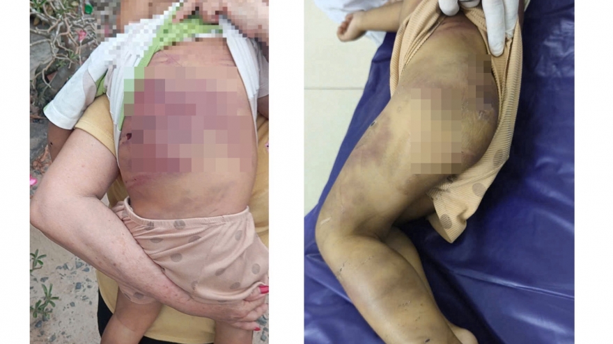 Bắt khẩn cấp “vợ chồng hờ” bạo hành, khiến bé gái 2 tuổi nguy kịch