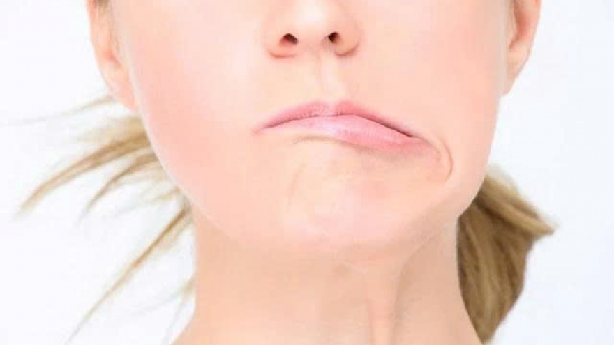 Méo miệng, lệch mặt giữa mùa hè: Nguyên nhân ít ai ngờ tới